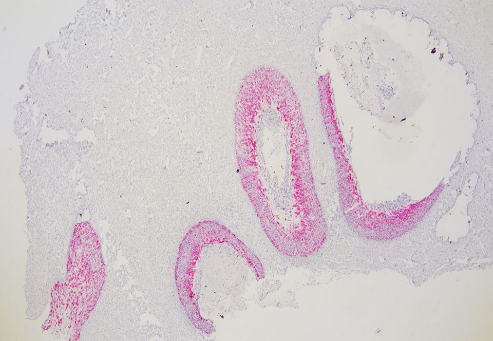 HPV HR18高危多亚型检测试剂盒